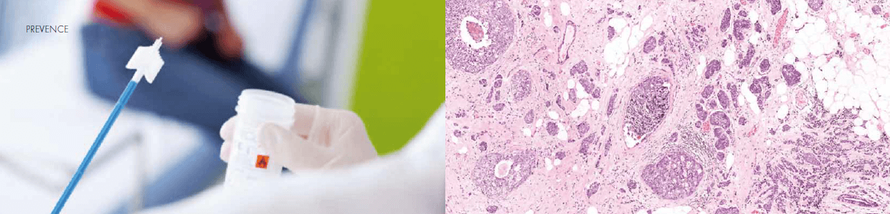 SCREENING KARCINOMU DĚLOŽNÍHO HRDLA A VÝZNAM TESTOVÁNÍ HPV